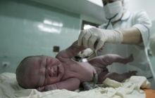 Рожденные с помощью кесарева сечения дети чаще толстеют